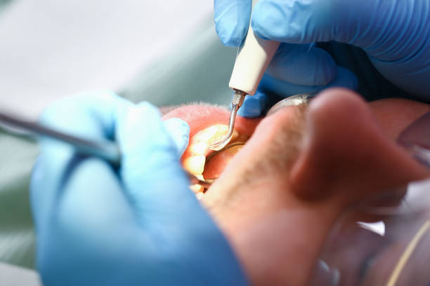 Best Emergency Root Canal Therapy in Milan, IN