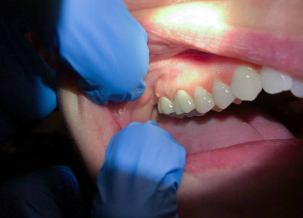 Best Dental Abscess Treatment in Milan, IN