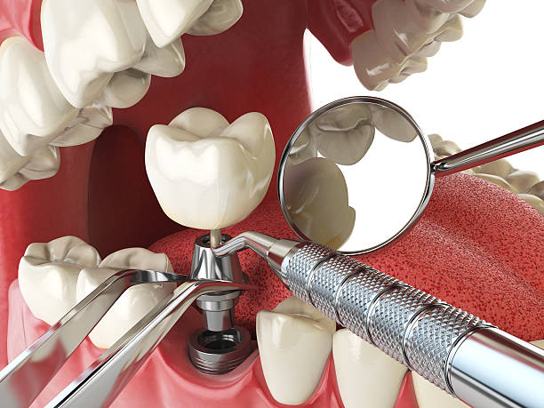 Best Lost Filling or Crown Replacement in Milan, IN